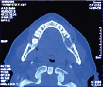 Tomograf&iacute;a
corte axial