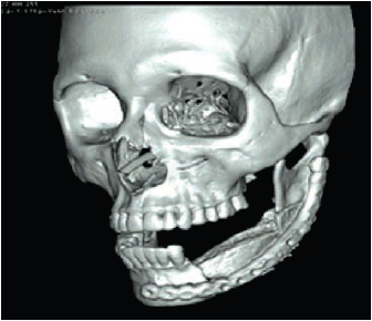 Reconstrucci&oacute;n
en 3D posquir&uacute;rgica