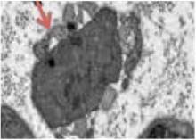 V&iacute;a regenerativa en el
nervio perif&eacute;rico distal a la lesi&oacute;n, compuesta por c&eacute;lulas de B&uuml;ngner elongadas
(flecha) o bandas de B&uuml;ngner