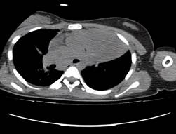 TAC de tórax:
masa de 17 mm en el interior de la luz distal del bronquio fuente izquierdo