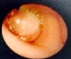 Fibrobroncoscopia: oclusión
del 100 % del bronquio fuente izquierdo