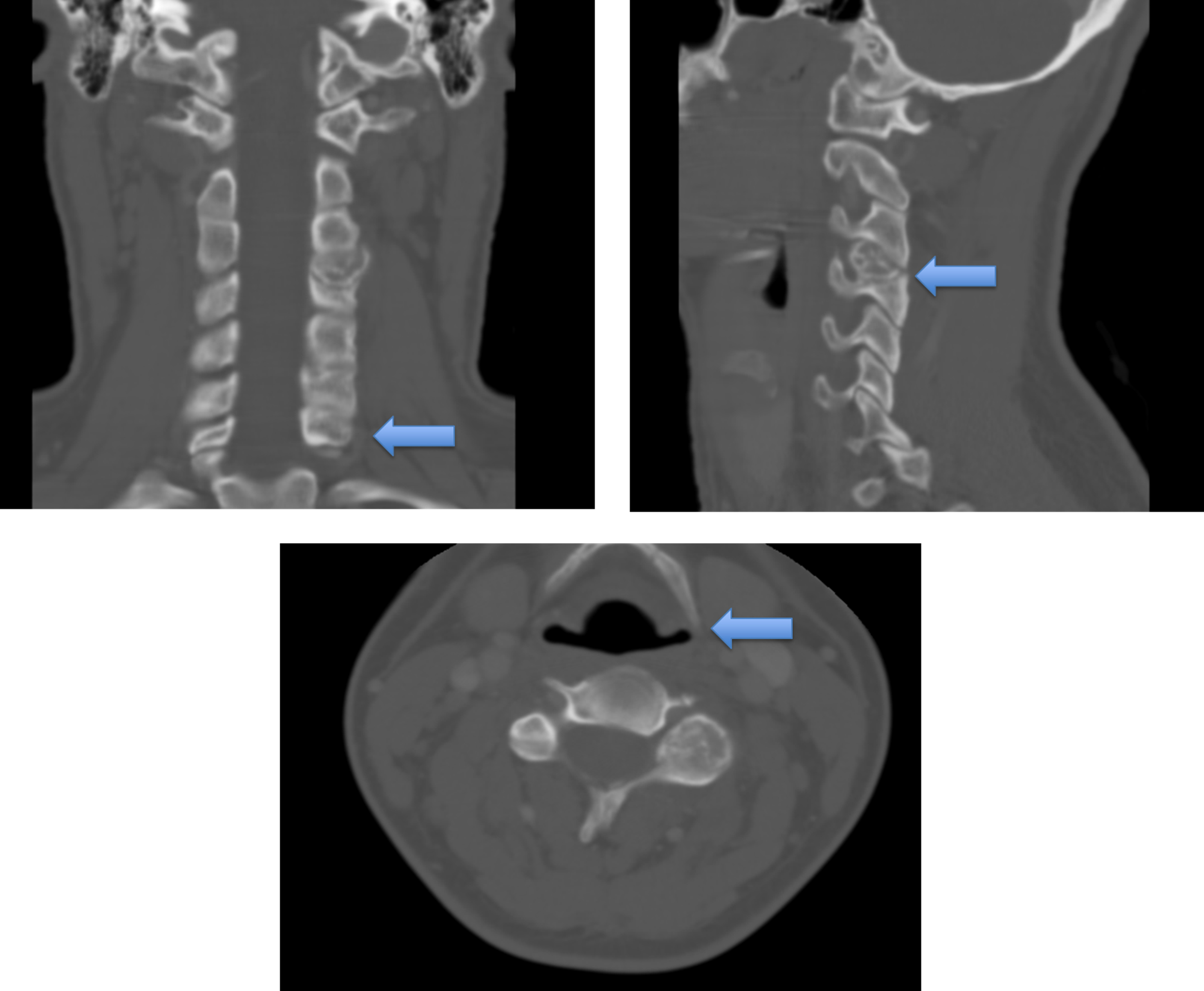 Tomograf&iacute;a axial computarizada en proyecciones coronal, sagital y axial que muestran
una lesi&oacute;n expansiva de aspecto l&iacute;tico que afecta la faceta articular superior izquierda
de C4