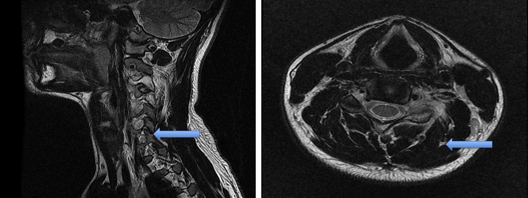 Resonancia magn&eacute;tica nuclear en T2: corte sagital y axial. Se evidencia una lesi&oacute;n
hiperintensa con irregularidad &oacute;sea del proceso articular
izquierdo de C4