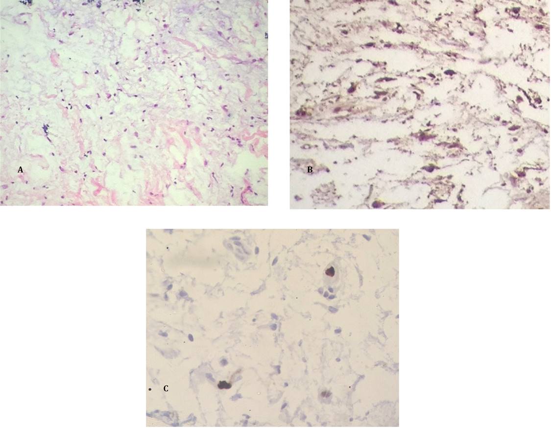 
A) Tinci&oacute;n con H-E con lesi&oacute;n de aspecto mixoide con c&eacute;lulas grandes y citoplasma
eosinof&iacute;lico. B) Inmunohistoqu&iacute;mica
positiva para prote&iacute;na S-100. C) Muestra que evidencia un &iacute;ndice de proliferaci&oacute;n
menor al 2&thinsp;%