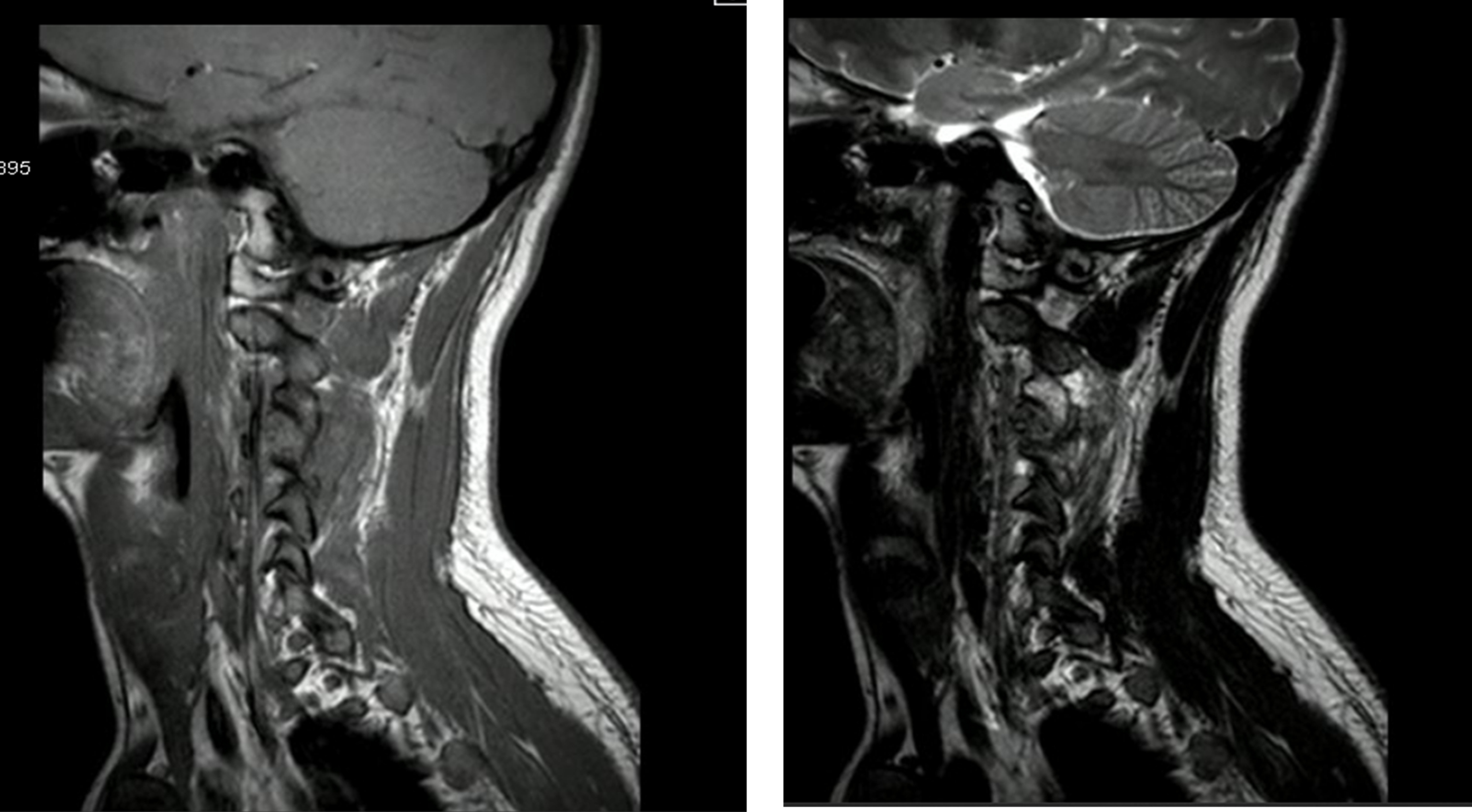 Corte sagital en T1 y T2. Se observan cambios posquir&uacute;rgicos por resecci&oacute;n en la
ap&oacute;fisis articular superior izquierda de C4