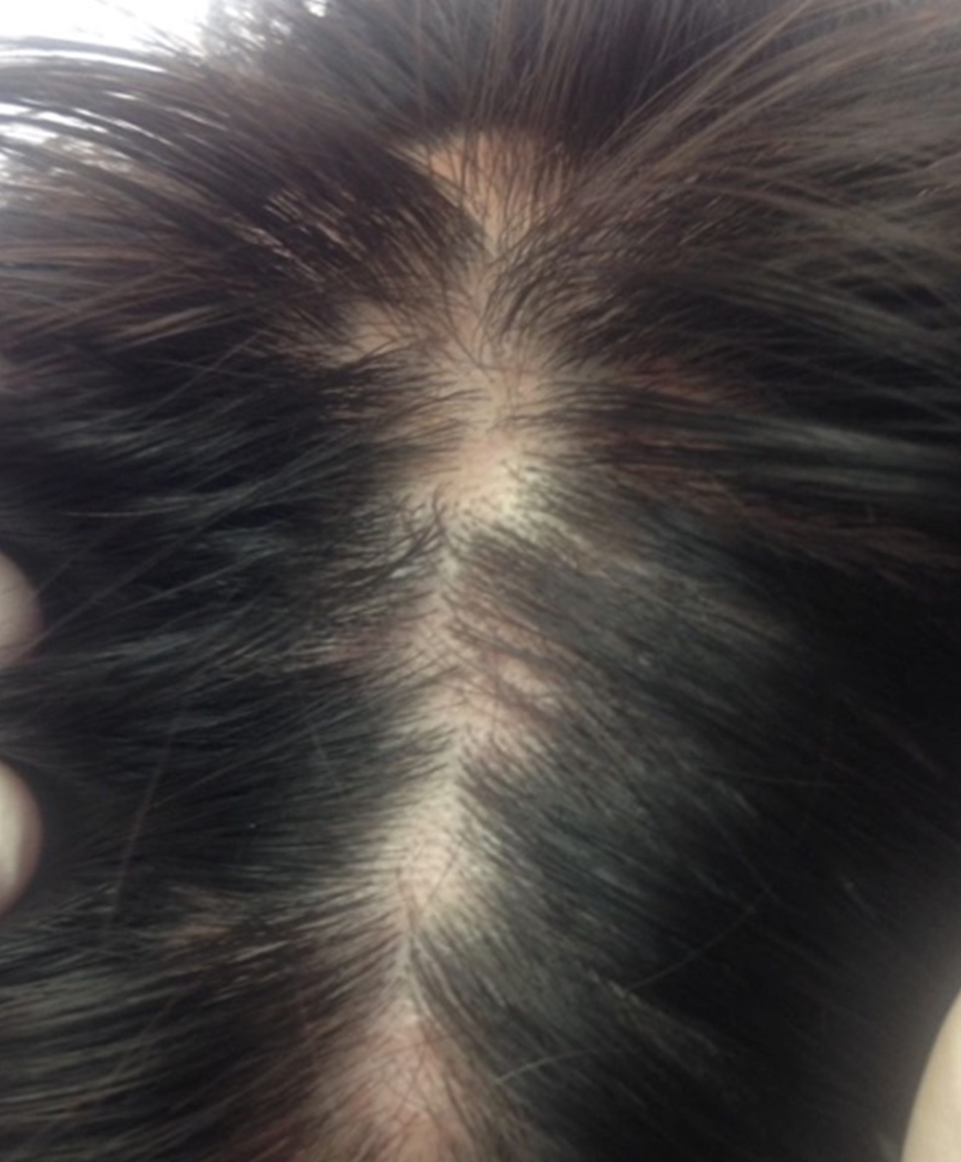 &Aacute;reas alop&eacute;cicas