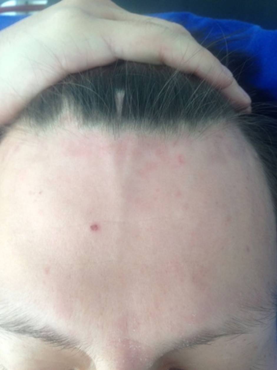 Placa pardo eritematosa descamativa en disposici&oacute;n de
corona