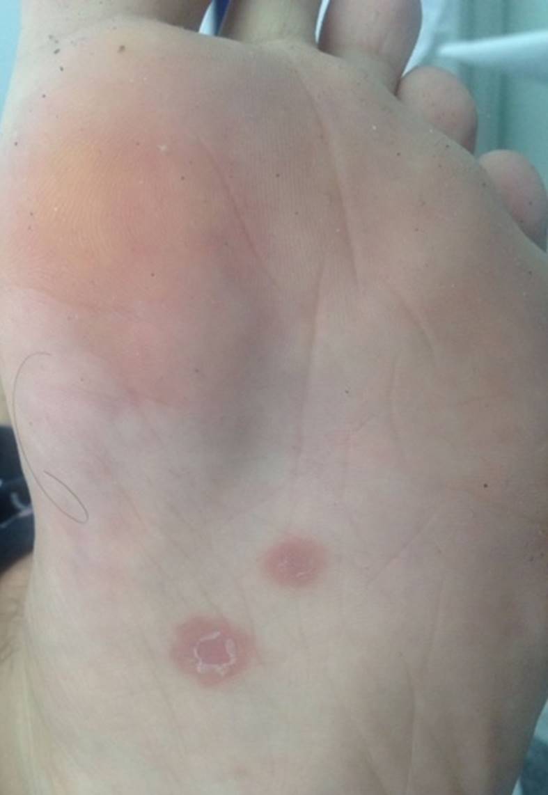 Placa con descamaci&oacute;n central