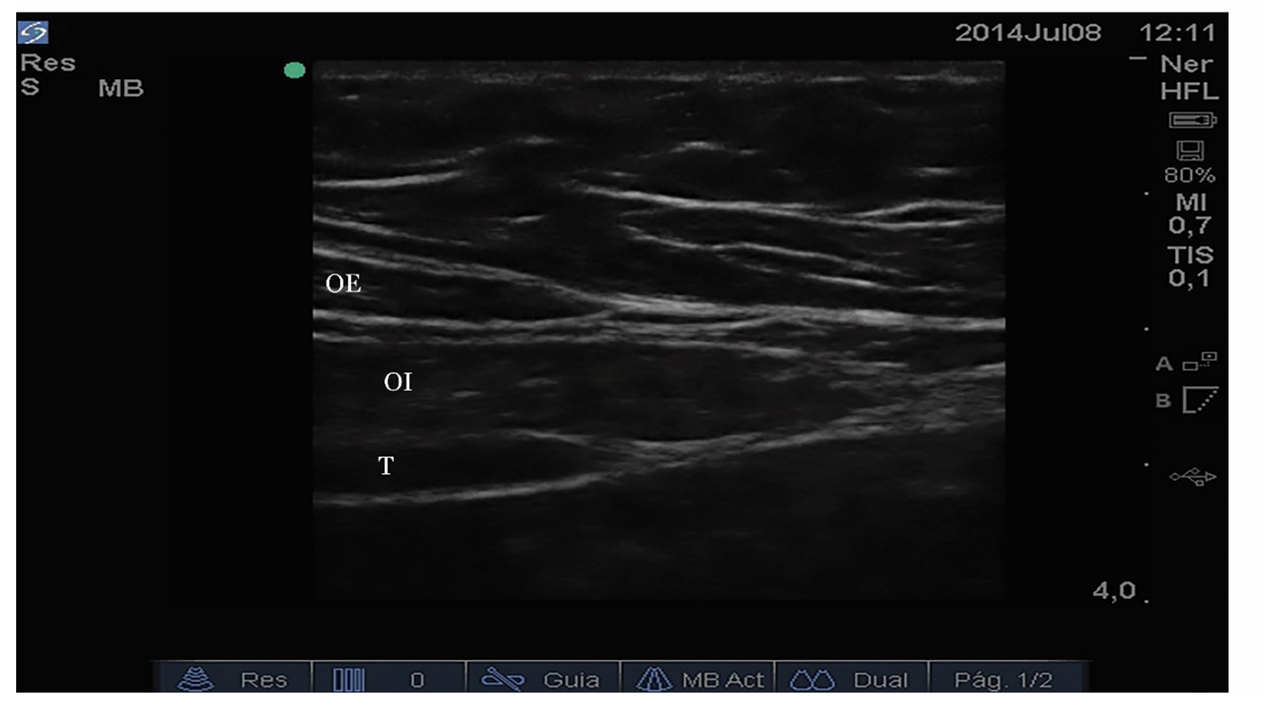 Convergencia de fascias de oblicuo externo (OE), oblicuo interno (OI) y transverso
T) en el borde lateral del recto abdominal (l&iacute;nea semilunar)