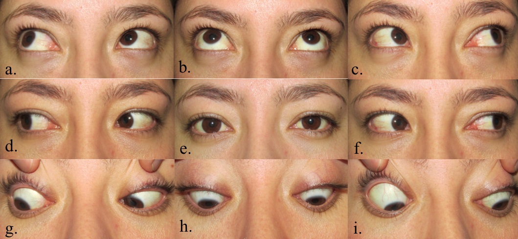 Versiones.
a) Dextrosupraversi&oacute;n; b) Supraversi&oacute;n; c) Levosupraversi&oacute;n;
d) Dextroversi&oacute;n; e) Posici&oacute;n primaria de la mirada; f) Levoversi&oacute;n; g) Dextroinfraversi&oacute;n;
h) Infraversi&oacute;n; i) Levoinfraversi&oacute;n
