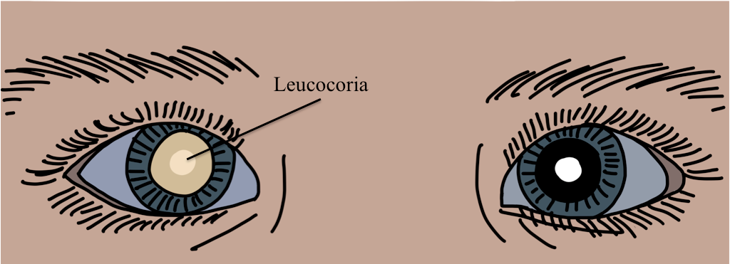 Ausencia de
reflejo rojo (debido a leucocoria) de ojo izquierdo en
paciente con catarata cong&eacute;nita