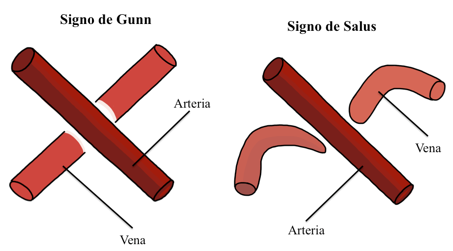 Signo de Gunn y signo de Salus