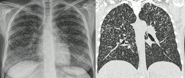 Afectaci&oacute;n
pulmonar por tuberculosis