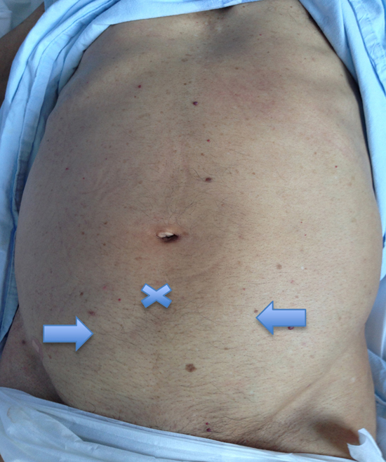 Sitios de punci&oacute;n para paracentesis