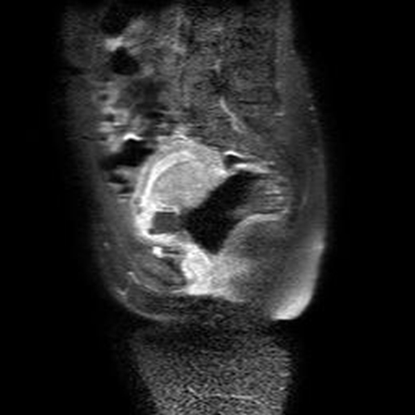 A) Imagen sagital de RMN en T1 que muestra el miometrio
y el saco gestacional de baja se&ntilde;al, lo cual limita su diferenciaci&oacute;n. B). Imagen
sagital de T1 con gadolinio y supresi&oacute;n grasa que evidencia el realce normal del
miometrio y el saco gestacional hipointenso y sin realce