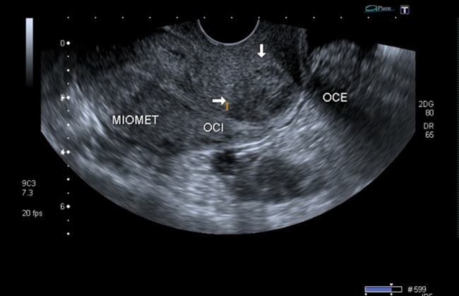 Presencia de imagen hipoecoica en el
labio anterior del cuello uterino que corresponde al tejido cicatricial.