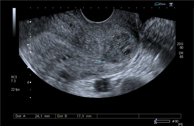 Imagen hipoecoica en el labio anterior
de 24,1 &times; 17,9 mm
