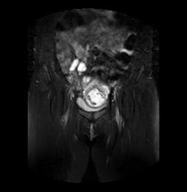 Im&aacute;genes de RMN potenciadas en T2 con supresi&oacute;n de
la grasa. A) Plano axial y B) Plano coronal, donde se identifica el saco gestacional
como una estructura qu&iacute;stica con tejido fetoplacentario en su interior y localizado
en el canal cervical