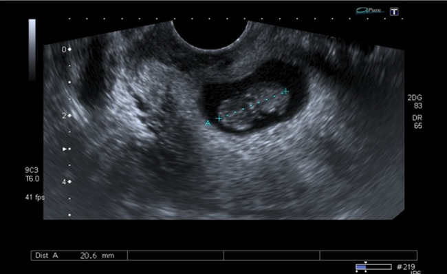 Polo embrionario de 20,6 mm sin actividad
cardiaca