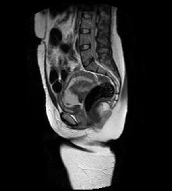 Im&aacute;genes sagitales de RMN potenciadas en T2
(TR: 1540 TE: 70) y T2 de disparo &uacute;nico (TR: 709 TE: 315) que muestran el saco gestacional
hiperintenso localizado en el canal cervical y con tejido fetoplacentario en su
interior, m&aacute;s evidente en la imagen B. N&oacute;tese que los orificios cervicales interno
y externo se encuentran cerrados