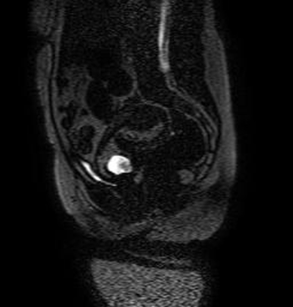 Im&aacute;genes sagitales de RMN potenciadas en T2
(TR: 1540 TE: 70) y T2 de disparo &uacute;nico (TR: 709 TE: 315) que muestran el saco gestacional
hiperintenso localizado en el canal cervical y con tejido fetoplacentario en su
interior, m&aacute;s evidente en la imagen B. N&oacute;tese que los orificios cervicales interno
y externo se encuentran cerrados