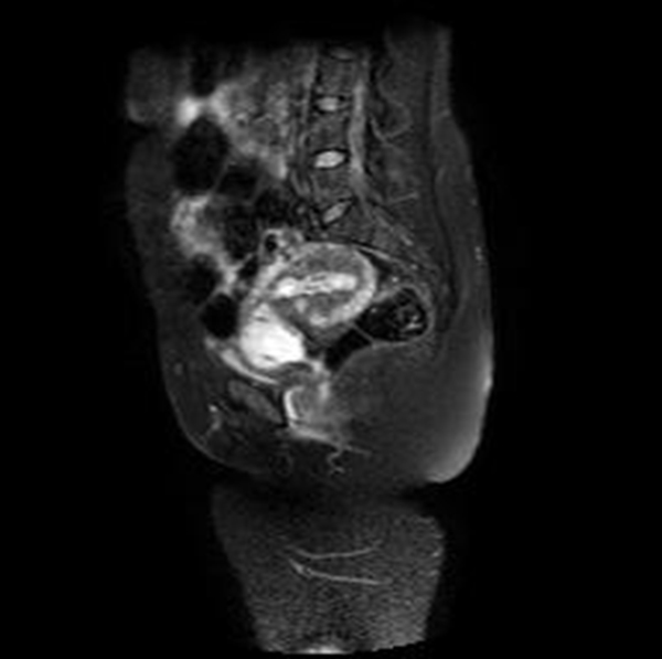 Imagen sagital de RMN en T2 con supresi&oacute;n grasa (SPIR)
que muestra el saco gestacional limitado anteriormente por una banda de se&ntilde;al intermedia
correspondiente a la reacci&oacute;n decidual y rodeada a su vez por el miometrio hipointenso