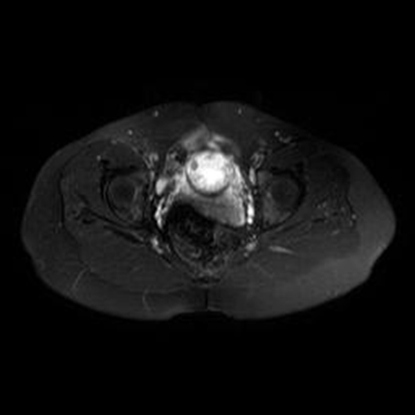 Im&aacute;genes de RMN potenciadas en T2 con supresi&oacute;n de
la grasa. A) Plano axial y B) Plano coronal, donde se identifica el saco gestacional
como una estructura qu&iacute;stica con tejido fetoplacentario en su interior y localizado
en el canal cervical