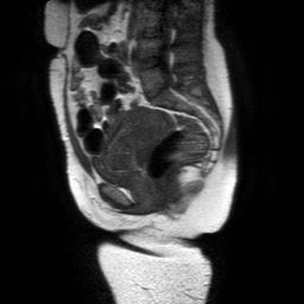 A) Imagen sagital de RMN en T1 que muestra el miometrio
y el saco gestacional de baja se&ntilde;al, lo cual limita su diferenciaci&oacute;n. B). Imagen
sagital de T1 con gadolinio y supresi&oacute;n grasa que evidencia el realce normal del
miometrio y el saco gestacional hipointenso y sin realce