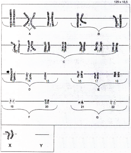 Karyotype 45, XX, rob(13;15)
(q10;q10)