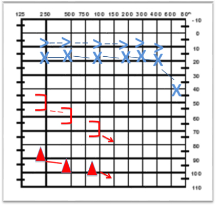 Audiometría con evidencia de hipoacusia neurosensorial
derecha severa