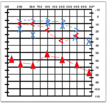 Audiometría con evidencia de hipoacusia mixta
con gap aéreo-óseo en frecuencias graves
y agudas