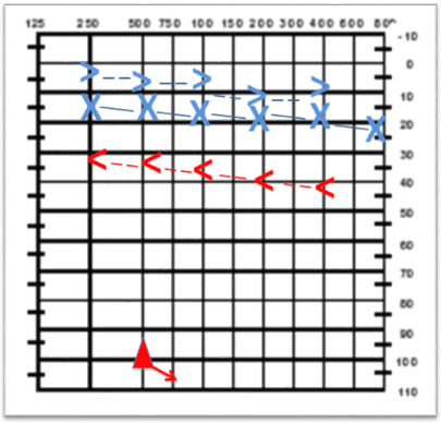 Audiometría con evidencia de hipoacusia neurosensorial
profunda derecha