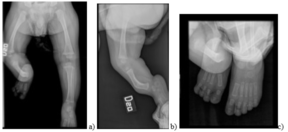 Radiograf&iacute;a de miembros inferiores y pies