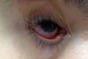 Secreción verdosa persistente. Corresponde
a nuestro paciente.