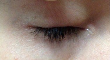 Lesiones oculares tarsales. Corresponde a nuestro paciente.