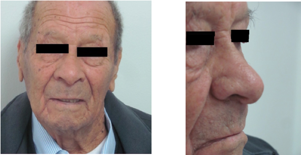 El paciente sin evidencia del tumor con buen resultado
cosmético 16 meses después de la radioterapia