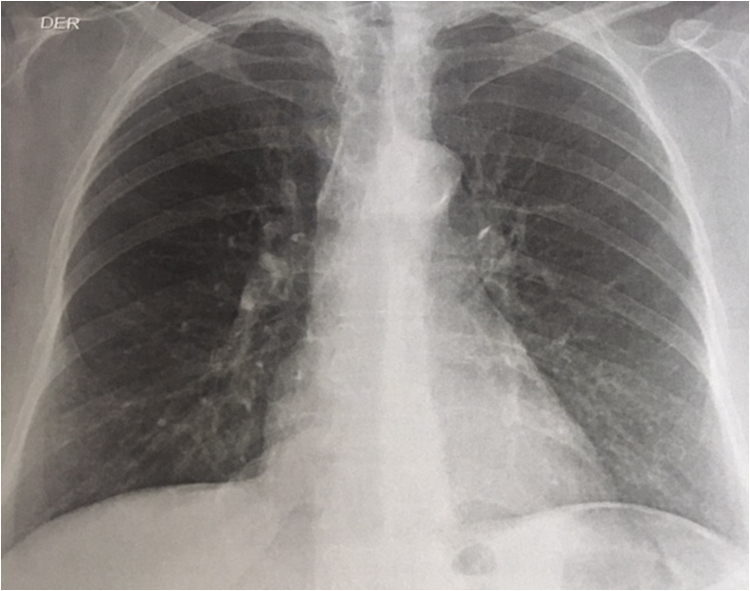 Radiografía de tórax del paciente, proyección posteroanterior que evidencia infiltrados
micronodulares parabronquiales y signos de hipertensión pulmonar, entre otros hallazgos
como atelectasia del lóbulo inferior derecho y elongación de la aorta