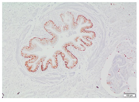 Factor de transcripci&oacute;n TTF-1
como marcador celular en patolog&iacute;a.