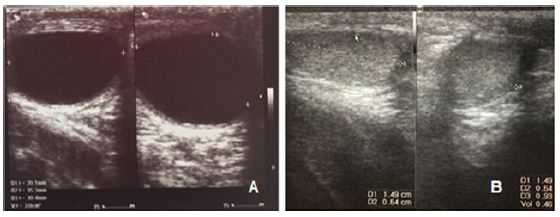 a) Ecograf&iacute;a preoperatoria: imagen anecoica, unilocular, circunscrita, de 19,2 &times; 11,5 &times; 17,1 mm (volumen calculado 2,0 ml). b) Ecograf&iacute;a postoperatoria: test&iacute;culo derecho de aspecto homog&eacute;neo de 13,3 &times; 6,3 &times; 10,6 mm (volumen calculado 0,5 ml)