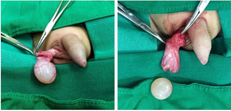 Masa qu&iacute;stica de 2 &times; 1,5 &times; 1,5 cm, blanquecina, de superficie lisa. Se realiza enucleaci&oacute;n completa por v&iacute;a escrotal respetando el par&eacute;nquima residual