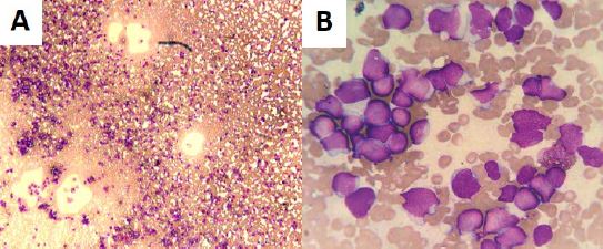 Aspirado de m&eacute;dula &oacute;sea en el momento del diagn&oacute;stico