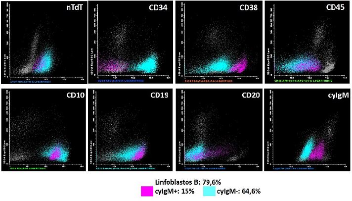 Representaci&oacute;n del an&aacute;lisis de la muestra de aspirado de m&eacute;dula &oacute;sea en el momento del diagn&oacute;stico