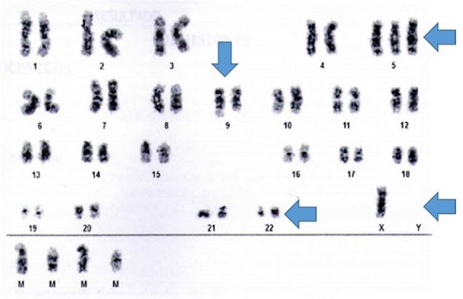 Resultado de cariotipo: 50, X, &minus;Y, +5, t(9;22) (q34;q11,2), +2mar2, +mar3 [5]/46, XY [15]. Translocaci&oacute;n (9;22) (q34;q11) con BCR-ABL y cromosoma filadelfia, presente en la m&eacute;dula &oacute;sea del paciente