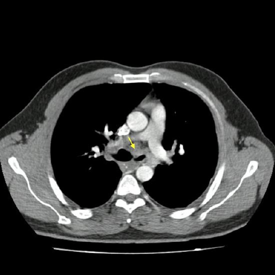 Tomograf&iacute;a axial computarizada de t&oacute;rax (ventana de mediastino) que muestra masa subcarinal que afecta el bronquio fuente izquierdo (flecha amarilla)