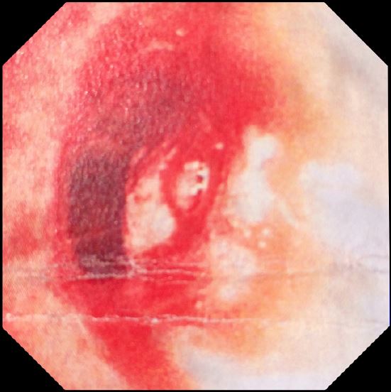 La broncoscopia confirma una masa hemorr&aacute;gica en el bronquio fuente izquierdo con disminuci&oacute;n de la luz en un 50%