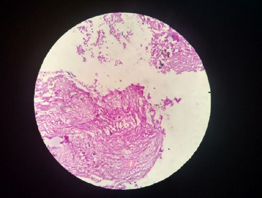 Tinci&oacute;n de &aacute;cido pery&oacute;dico de Schiff que evidencia estructuras redondeadas con contorno grueso (flecha amarilla) que corresponden morfol&oacute;gicamente a 
							Cryptococcus spp.
						