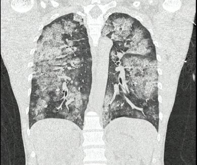 Tomografía de alta resolución de tórax (TACAR).