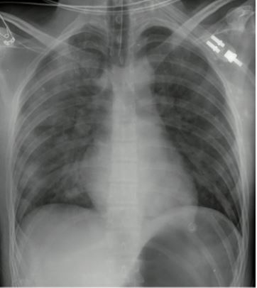 Radiografía de tórax.