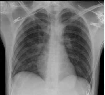 Radiografía de tórax.