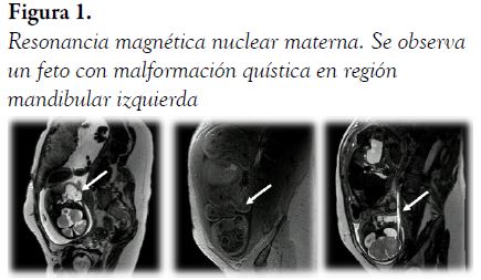 Resonancia magn&eacute;tica nuclear materna. Se observa un feto con malformaci&oacute;n qu&iacute;stica en regi&oacute;n mandibular izquierda